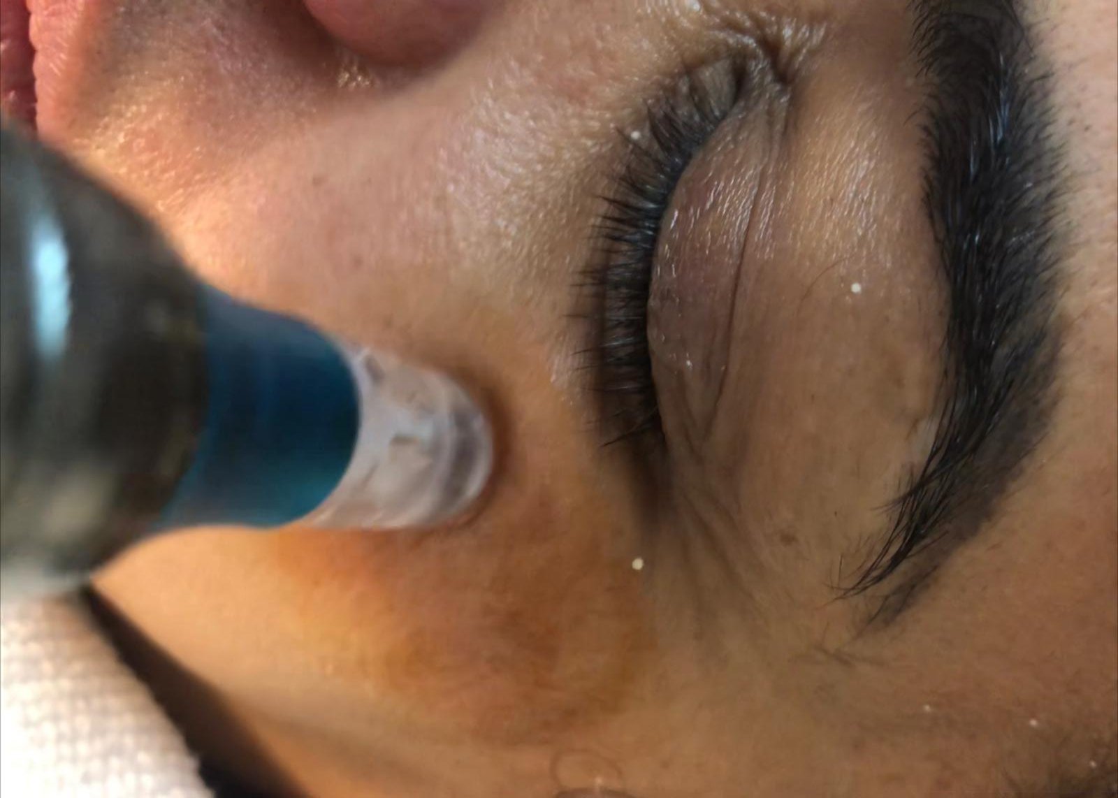 Microneedling Antimanchas